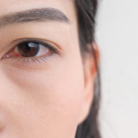 sindrome-occhio-secco-cause-rimedi